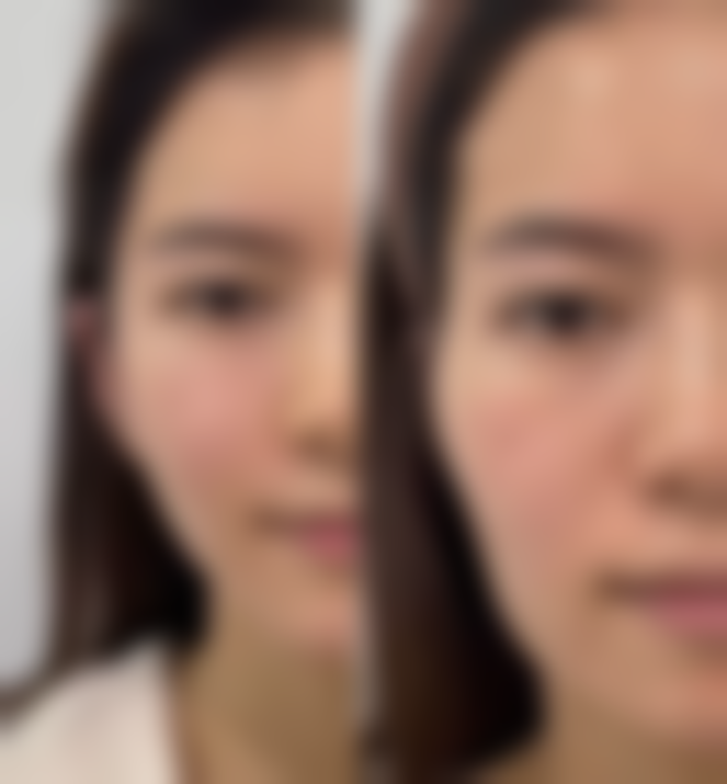 瘦脸针多少天开始有成效