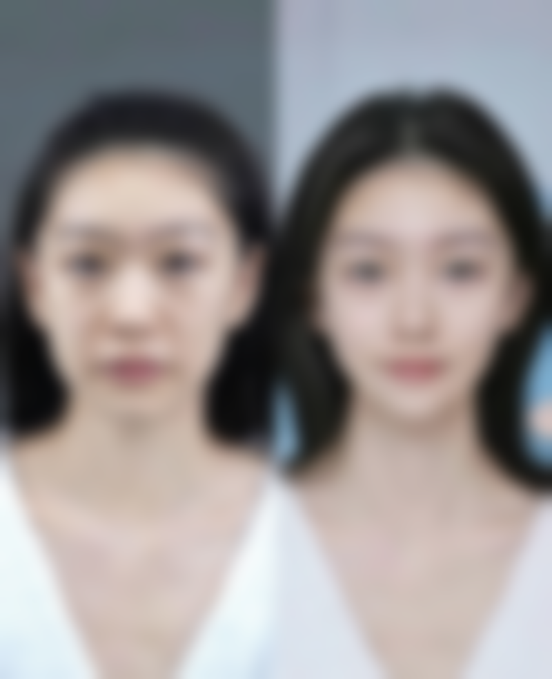 瘦脸治疗后的注意事项