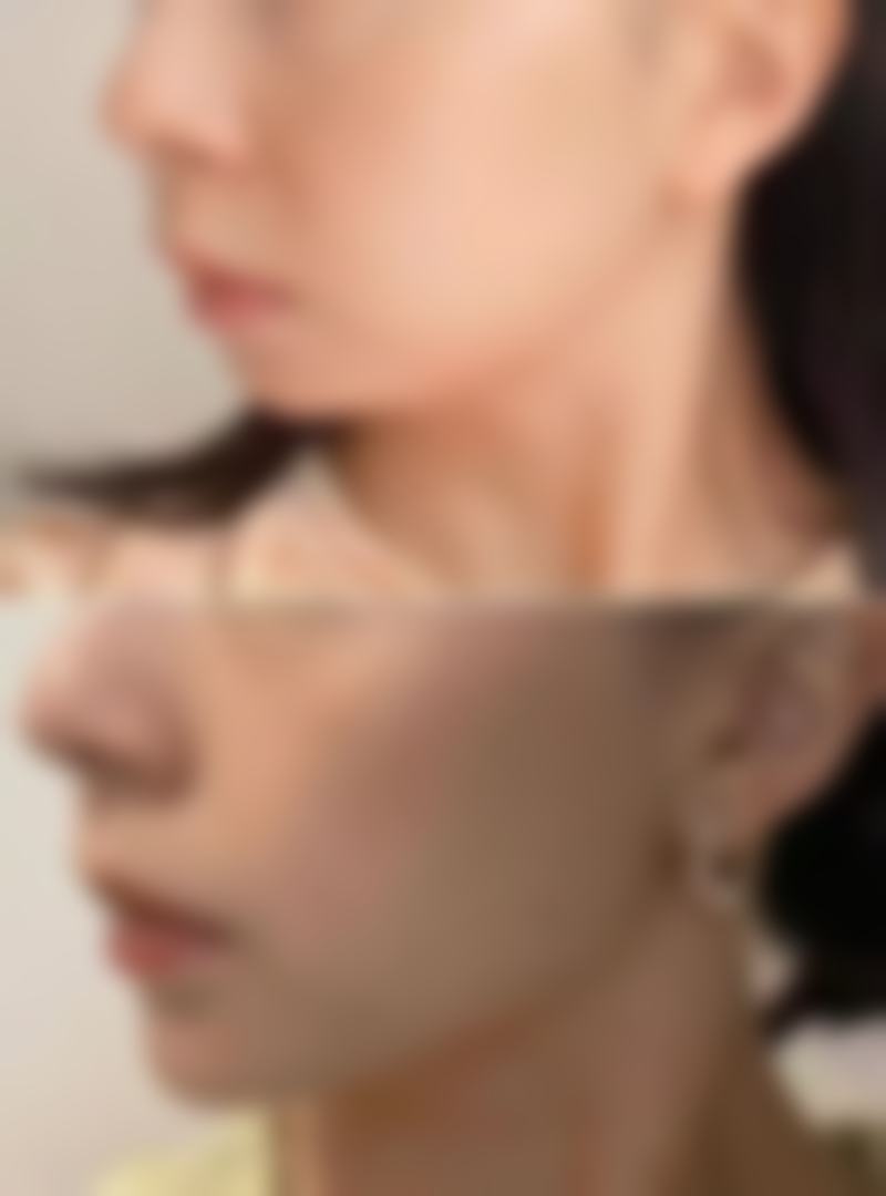 瘦脸针是多久成效明显