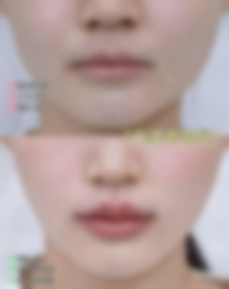 毛发种植手术过程