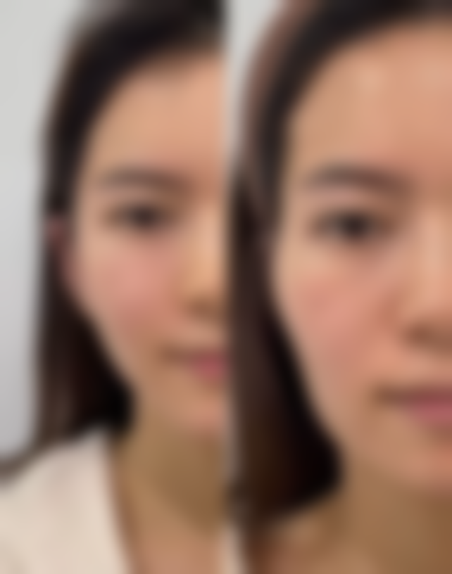 嘴唇太厚怎么办?常见的改善方法