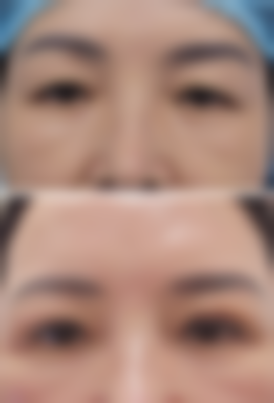 下巴怎么整形手术