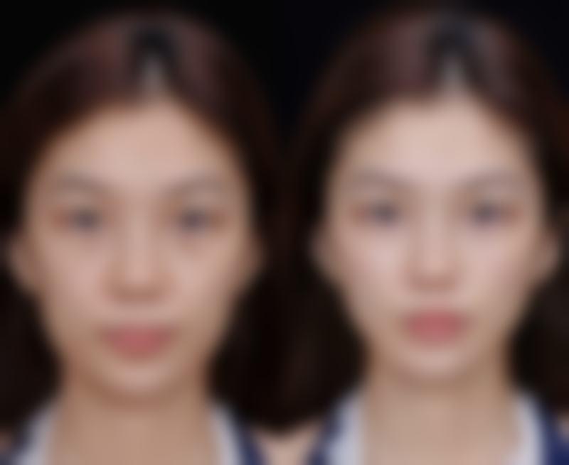 瘦脸针注射技巧教学