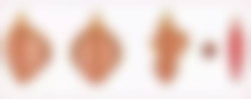 打瘦脸针脸歪了还能修复吗