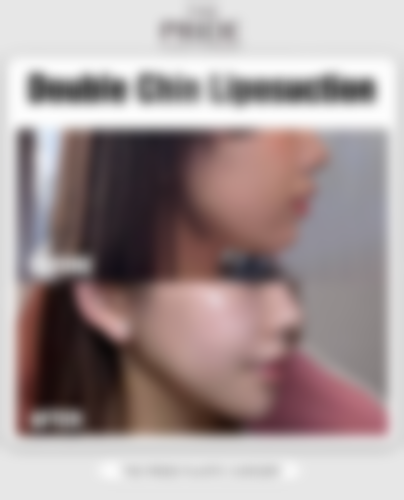 瘦脸针只对咬肌有成效吗？