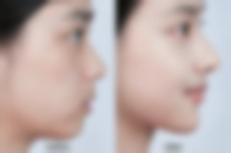 瘦脸针对咬肌有伤害吗？