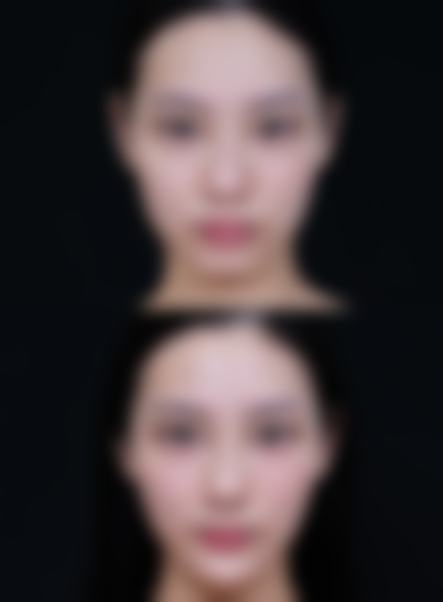 头发种植能保持多久时间