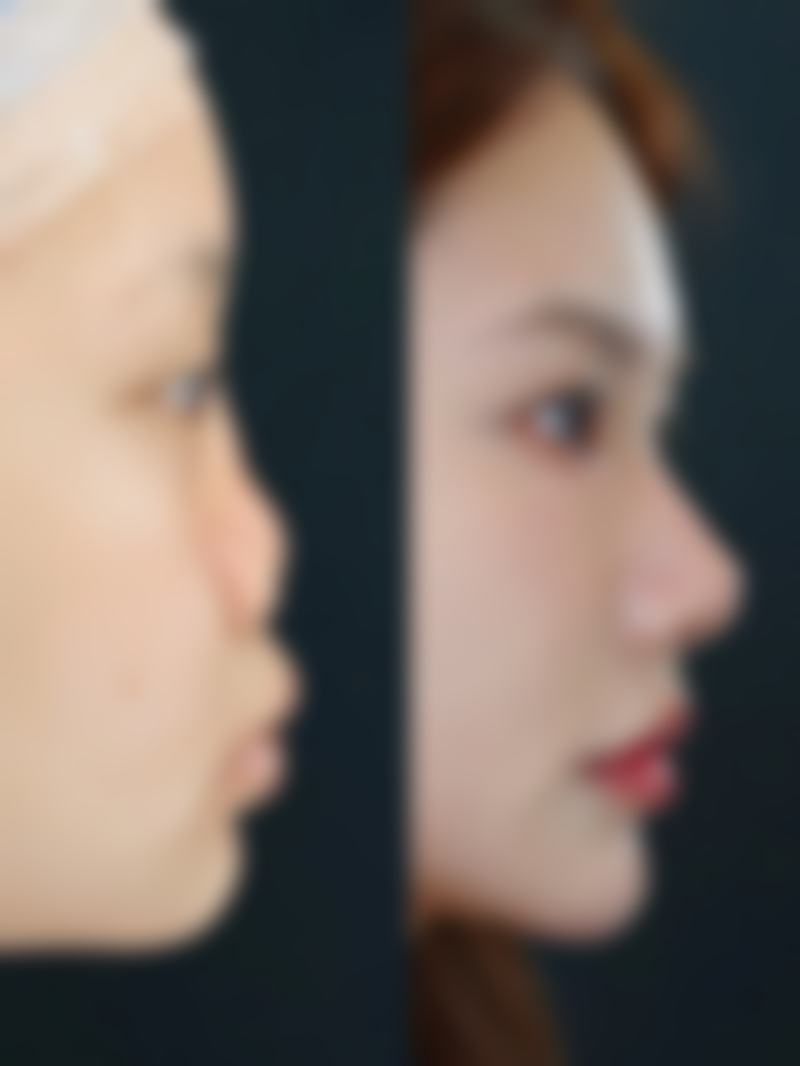 嘴巴能整容吗需要多少钱