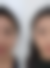 瘦脸针可以把咬肌完全打掉吗？