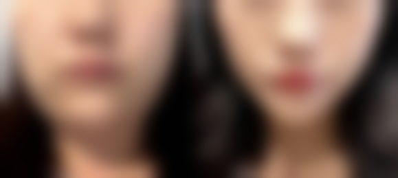 有胃病能打瘦脸针吗