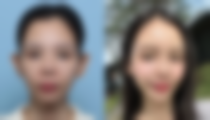 打瘦脸针有后遗症吗