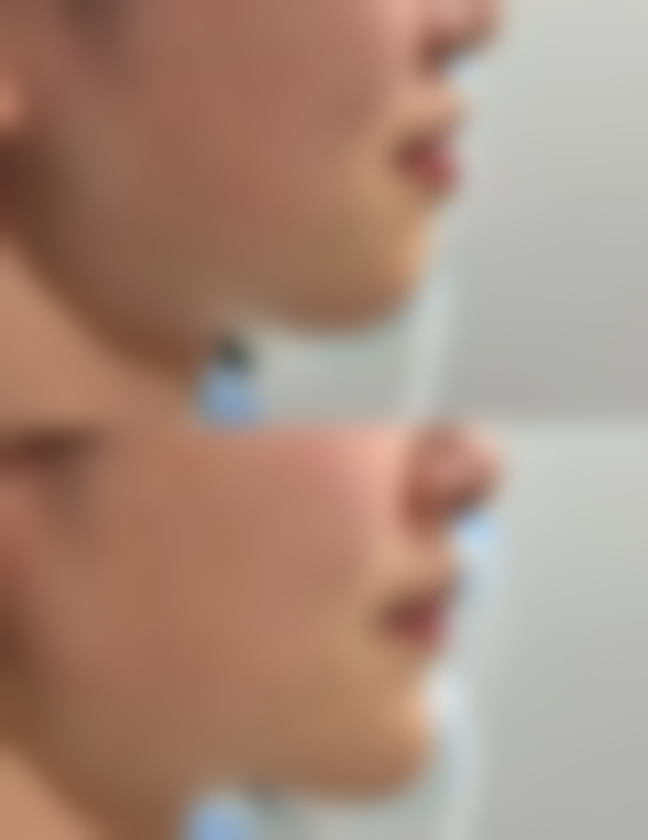 头发种植需要多长时间