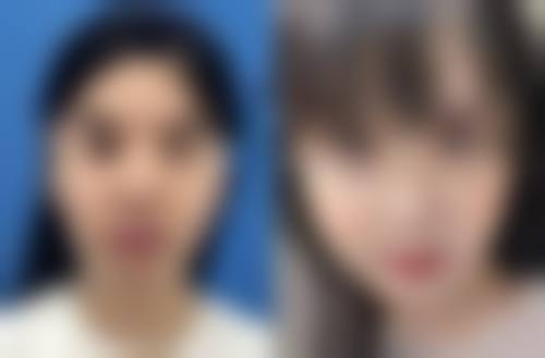 嘴角下垂做什么微整？3种热门医美手段揭秘，助你轻松上扬嘴角，重拾迷人笑容！ 