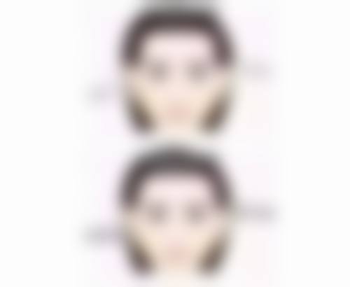 毛发种植一般植多少根头发