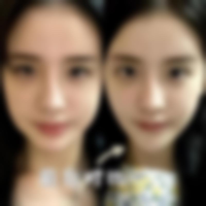 种植的毛发会长吗？答案是肯定的！揭秘植发后毛发自然生长的3大关键因素及护理秘诀 