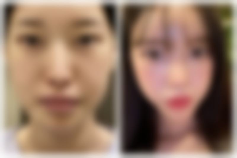 瘦脸针的价格及相关信息