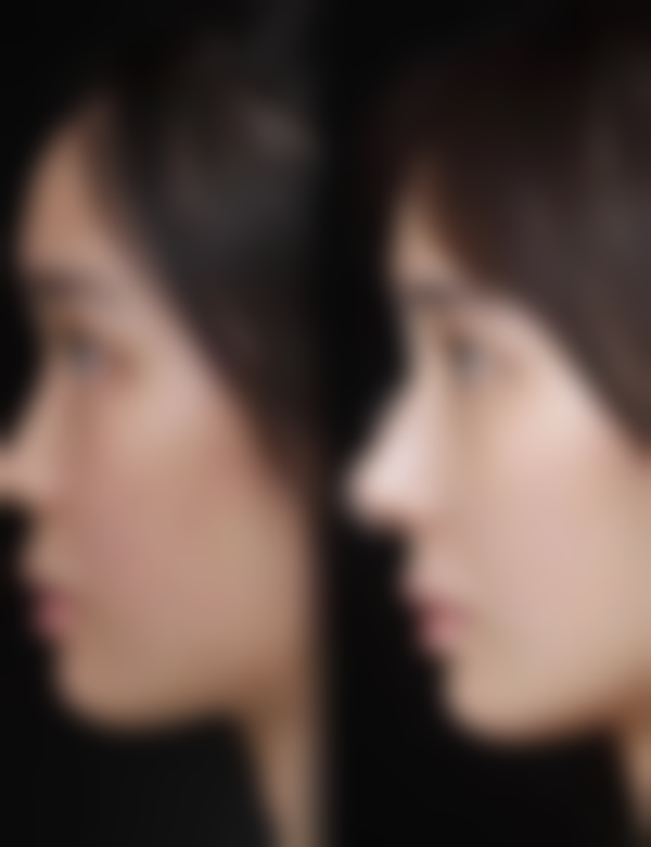 毛发种植一般植多少根合适