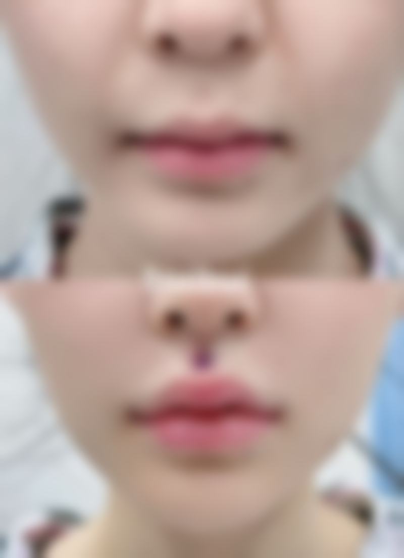 除皱针是打在皱纹上吗