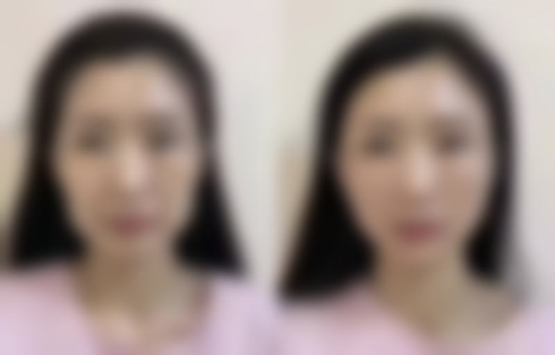 除皱是打除皱针吗多少钱