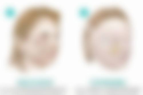 二、韩美瘦脸针的成效如何