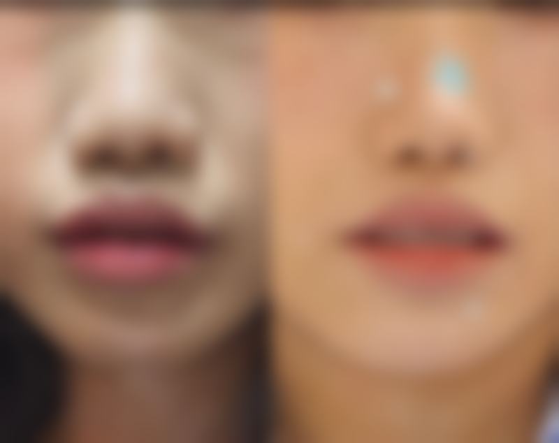 打瘦脸针会垮脸吗