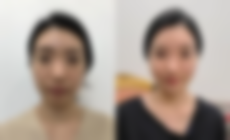 打一针瘦脸针有副作用吗