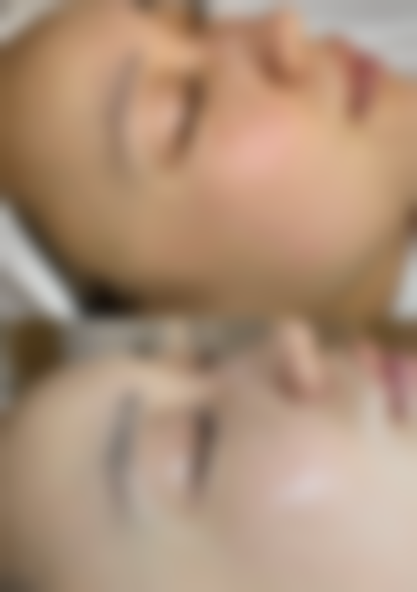 整容嘴会有什么副作用