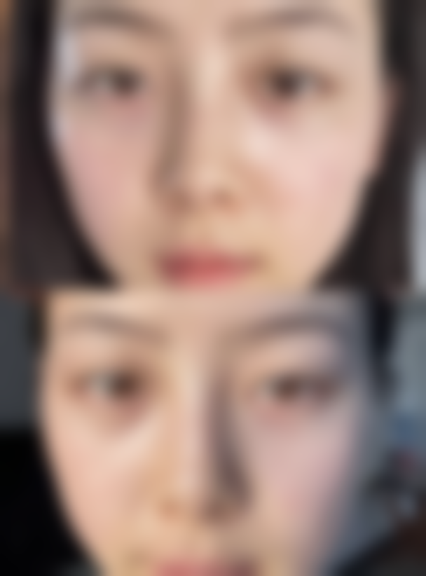 打瘦脸针脸歪了还能修复吗