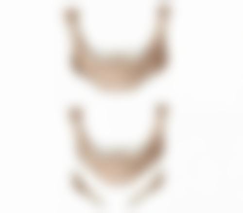 疤痕植发的实例分享