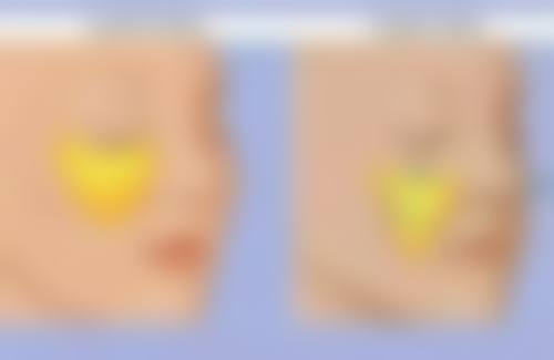 瘦脸针打完多久见效