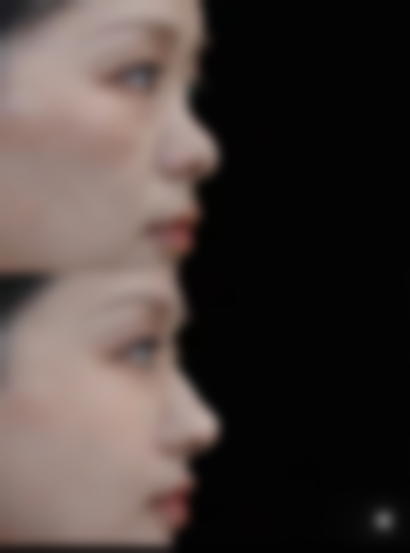 疤痕上种植头发的可行性