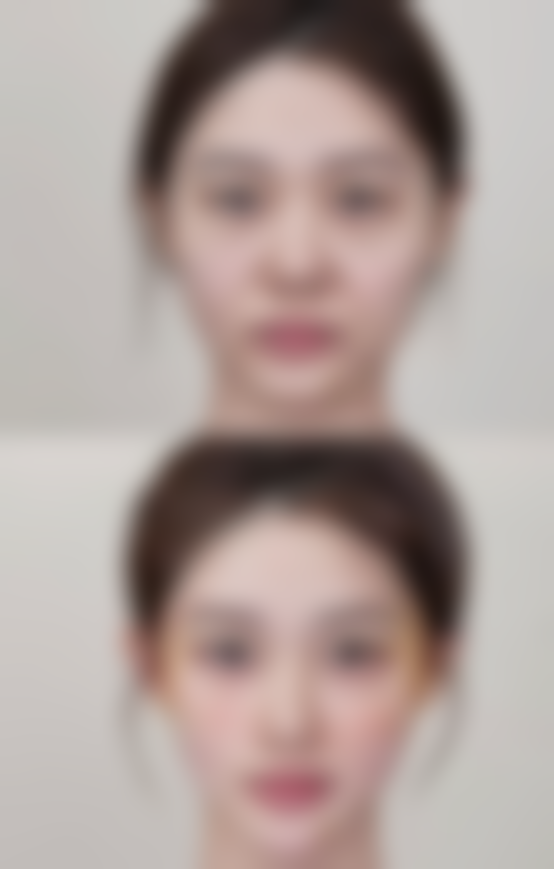 注射玻尿酸后有硬疙瘩怎么办