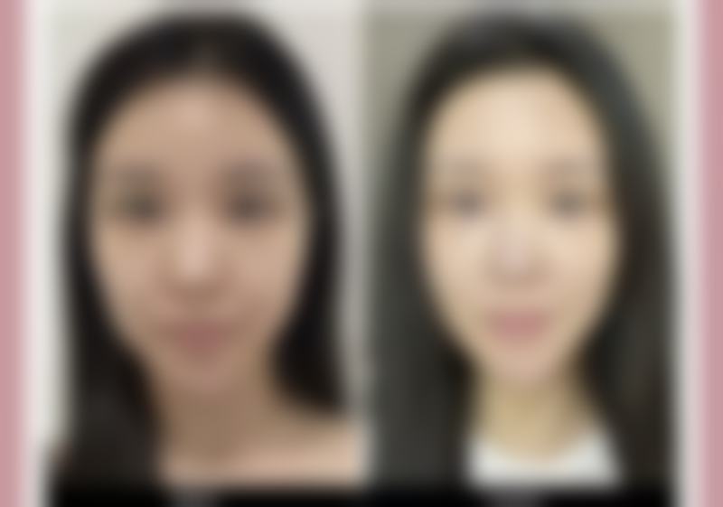 方脸打了瘦脸针后是什么成效图片