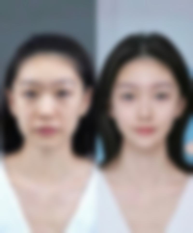 面部除皱用什么方法