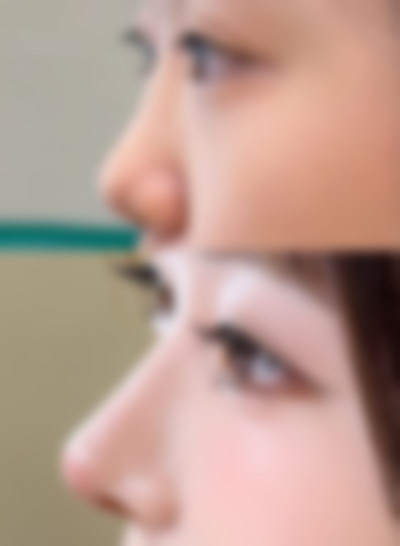 打美白针真的可以变白吗