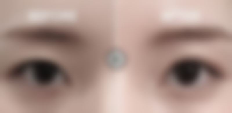 武汉斯启诺医美眼部整形项目的实例与口碑