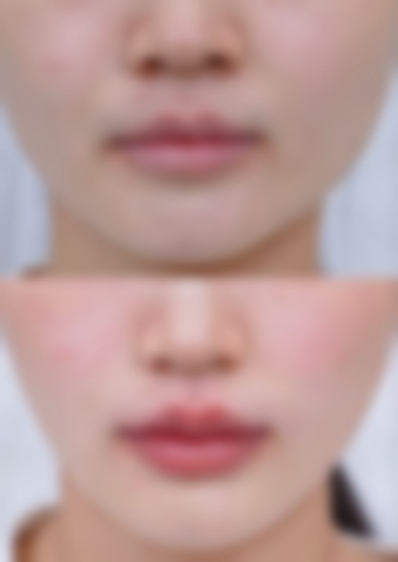 面部除皱提升全新的有效方法