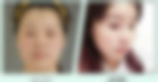 北京禾美嘉医美曼托水滴假体隆胸的技术优势