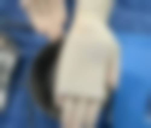 玻尿酸注射的其他应用及相关问题