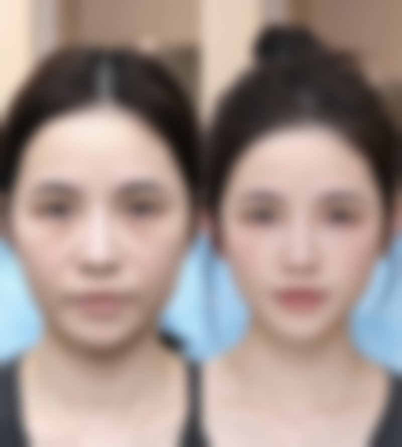 眼霜在抗皱中的作用