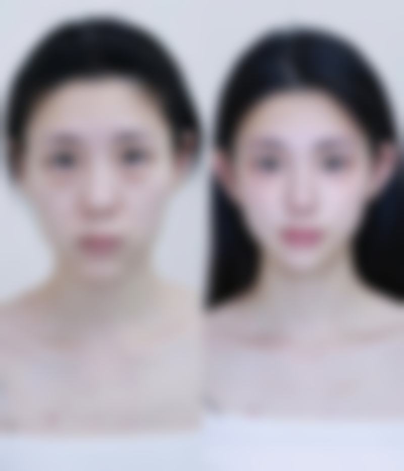 填充后的注意事项