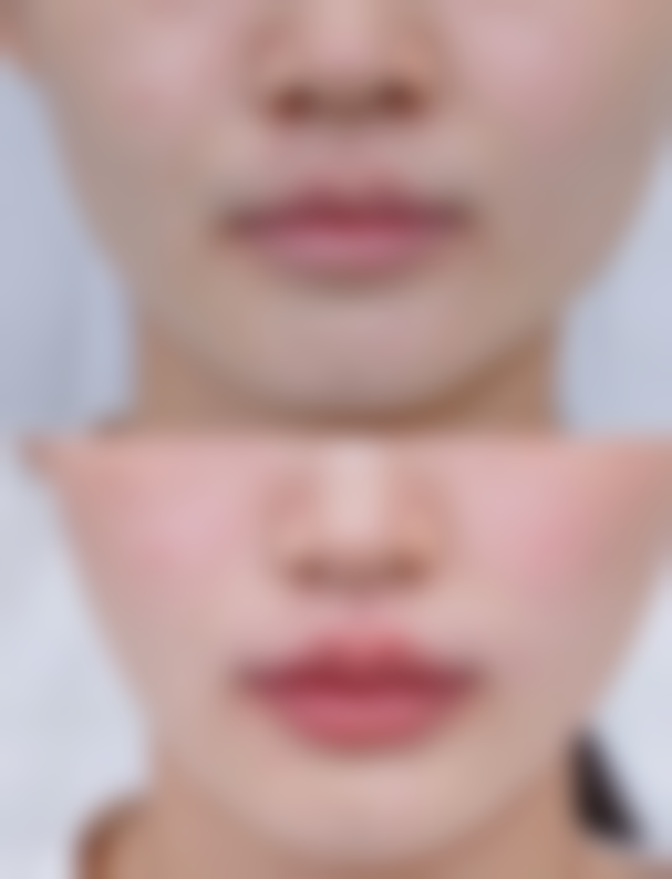 打美白针忌口哪些不能吃