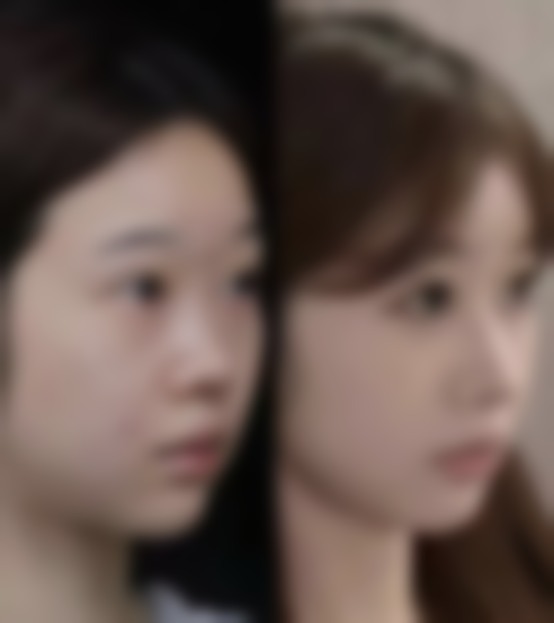 瘦脸针多少钱一次，要打几次定型