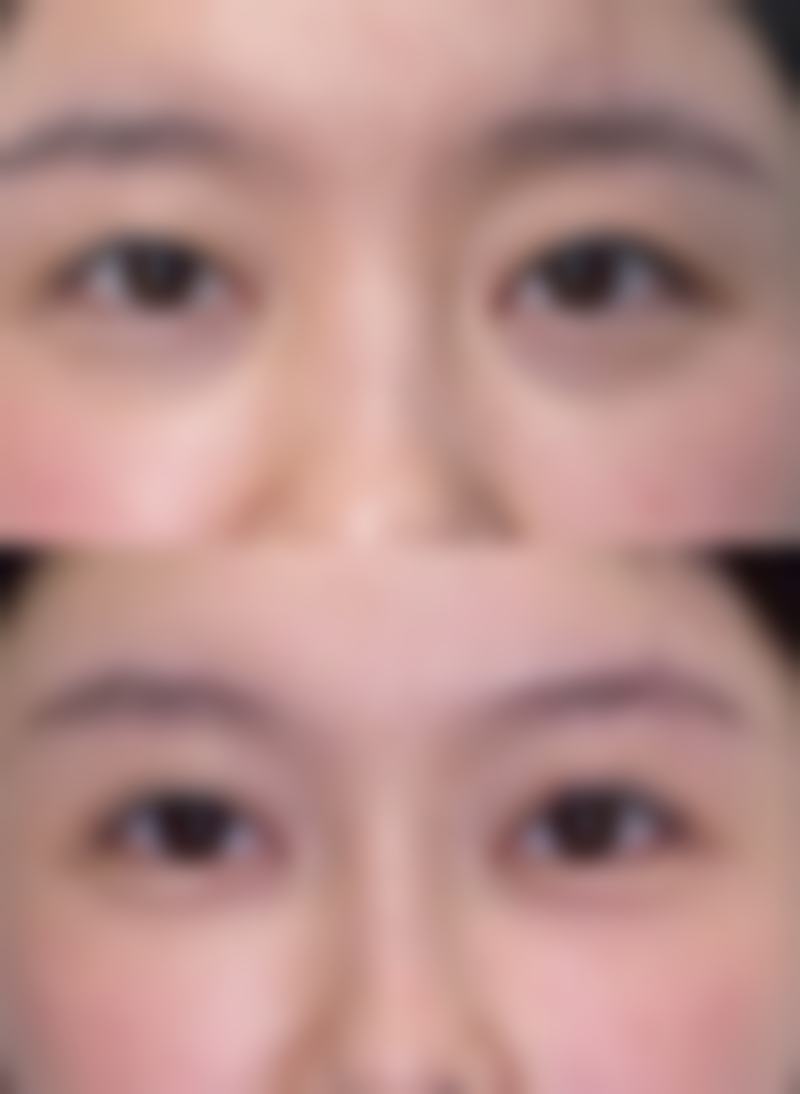 美容院除皱一般多少钱一次