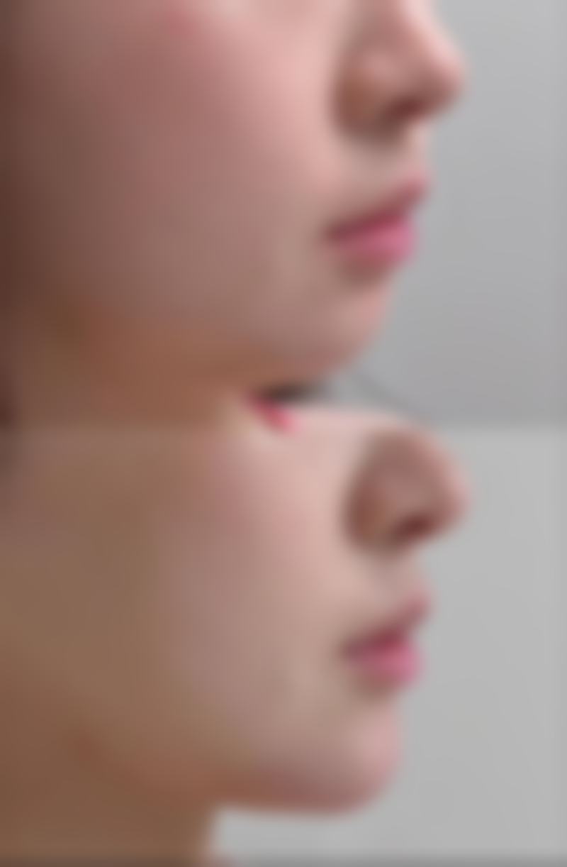 打美白针忌口哪些东西