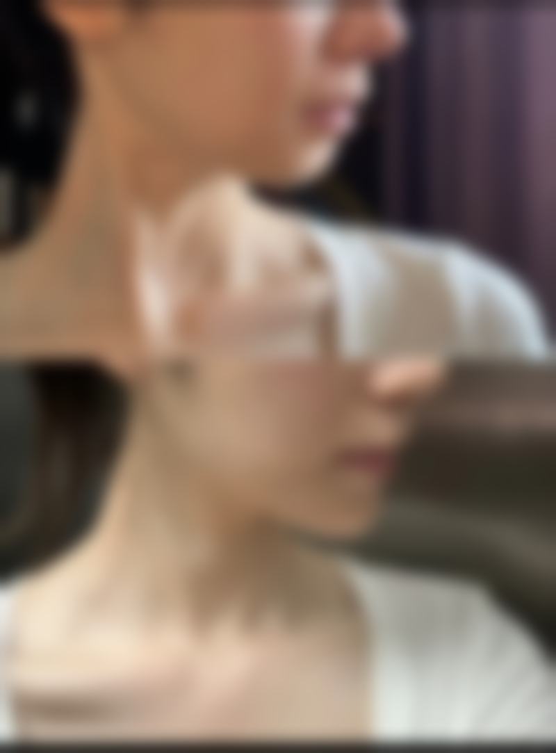 美容院除皱能维持多久