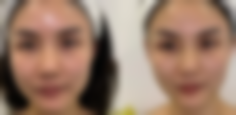 影响瘦脸针成效和修复时间的因素有哪些?