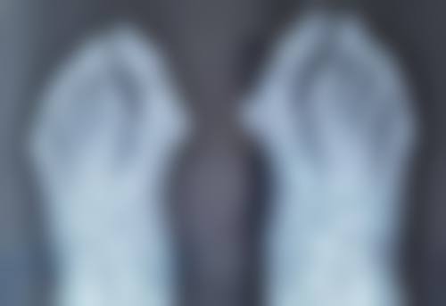 发际线种植效果怎么样？真人案例揭秘种植后发量暴增3倍，效果持久自然，堪称颜值逆袭神器！ 