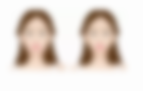 拉皮除皱大概价位