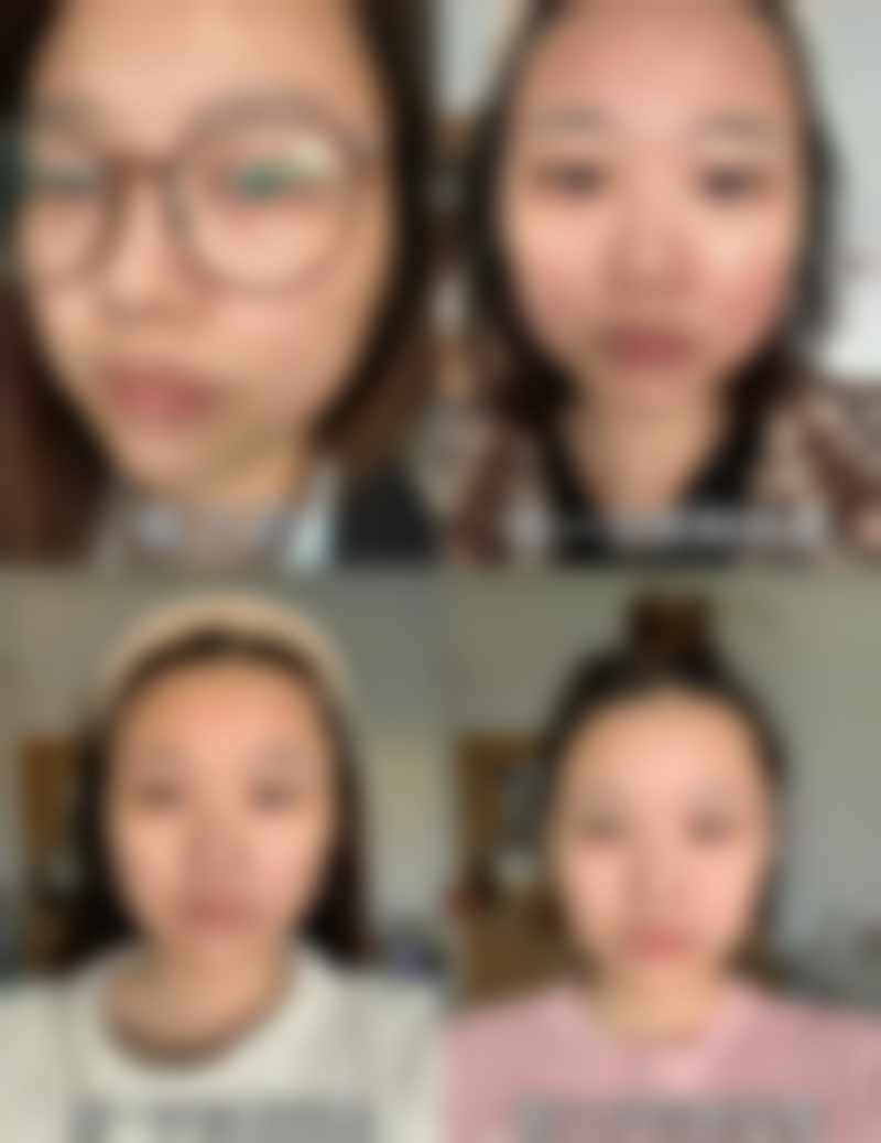 微针种植头发有什么危害